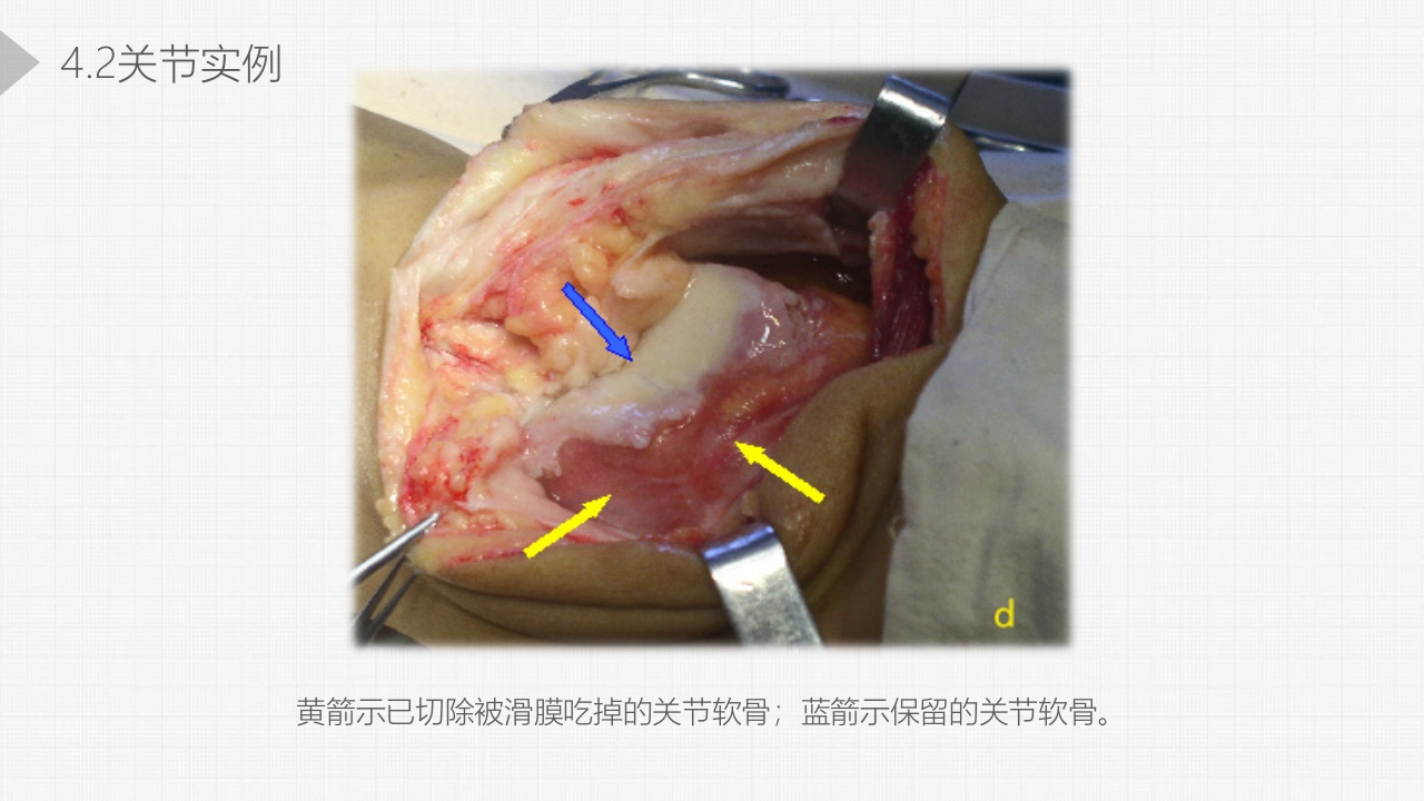 类风湿关节炎详细内容PPT课件9