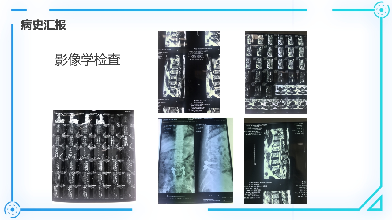 腰椎间盘突出症护理查房PPT课件15