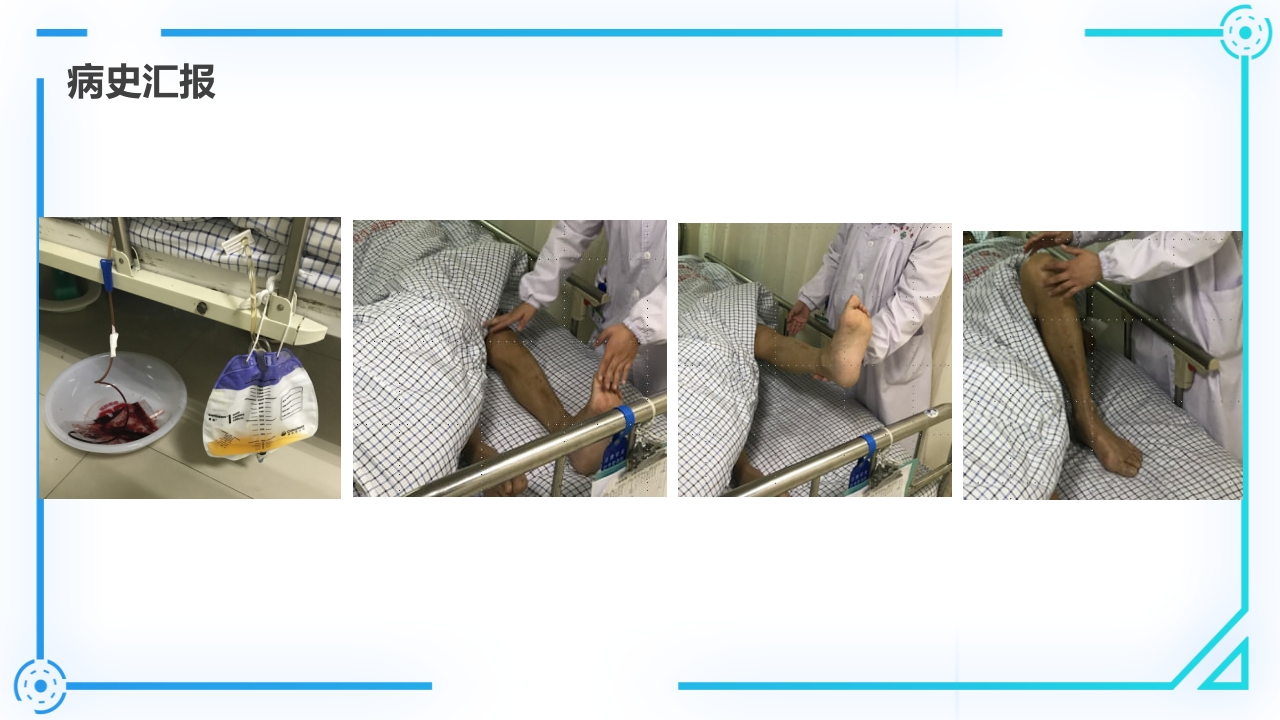 腰椎间盘突出症护理查房PPT课件17