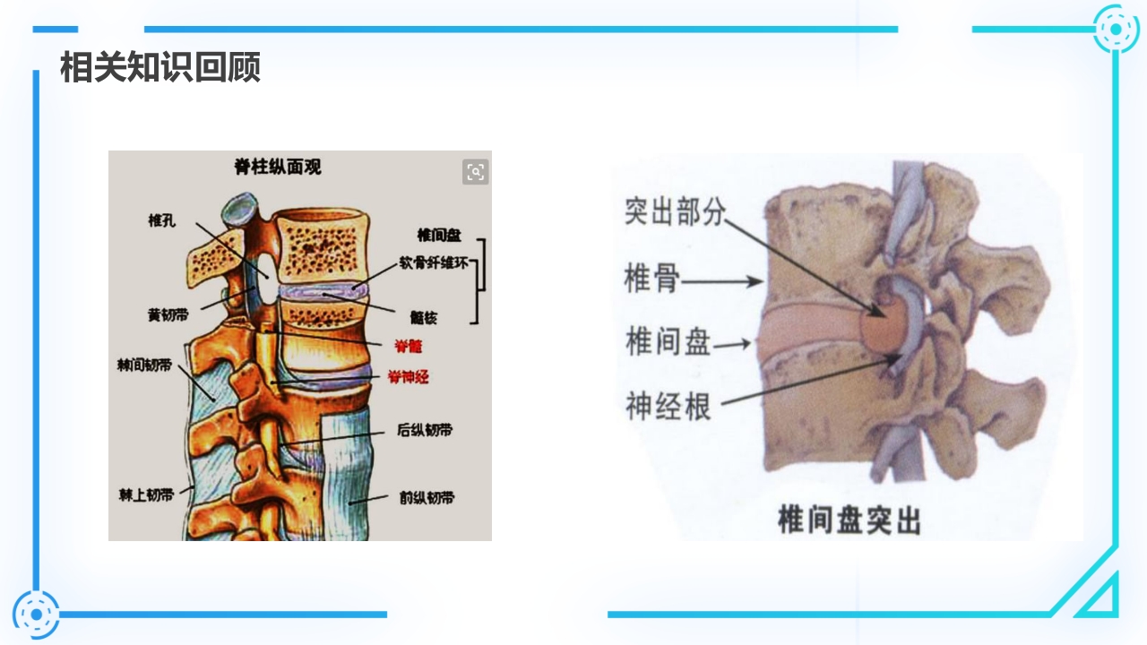 腰椎间盘突出症护理查房PPT课件4