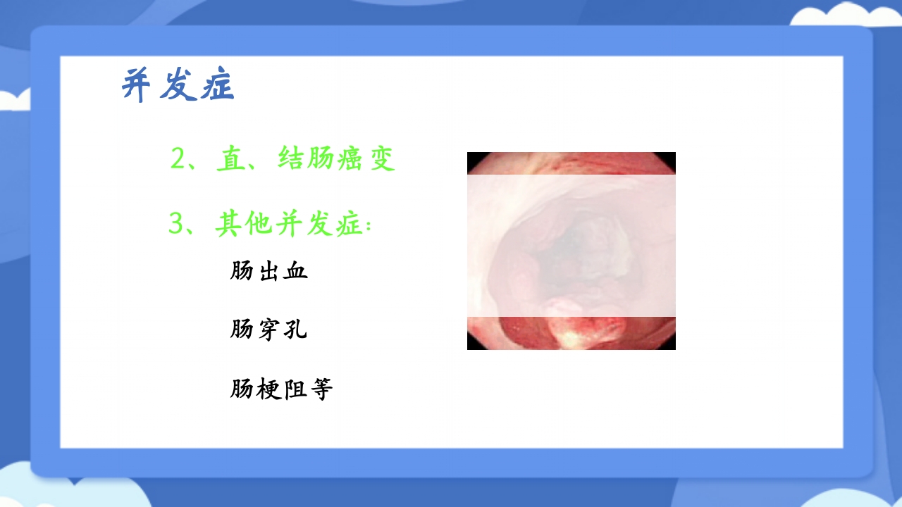 溃疡性结肠炎PPT课件15