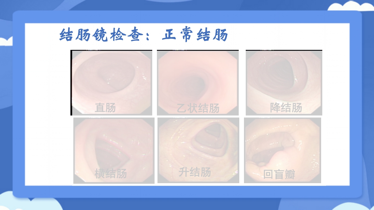 溃疡性结肠炎PPT课件20