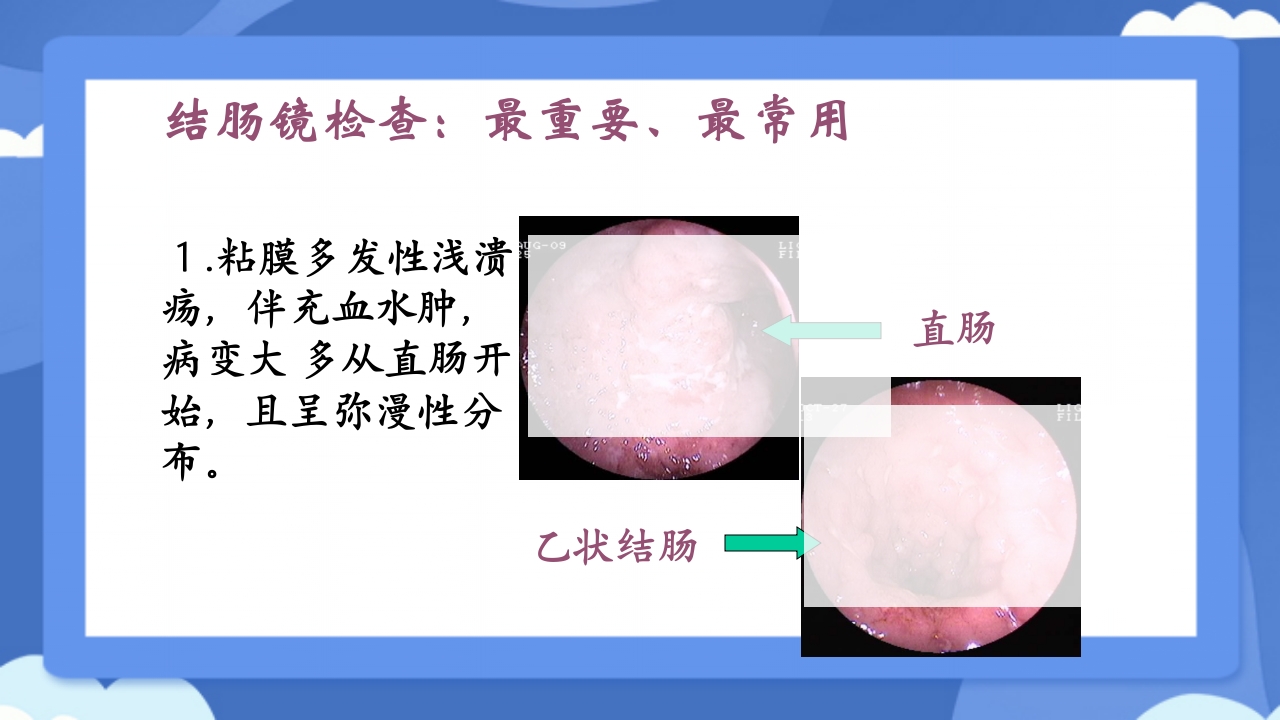溃疡性结肠炎PPT课件21