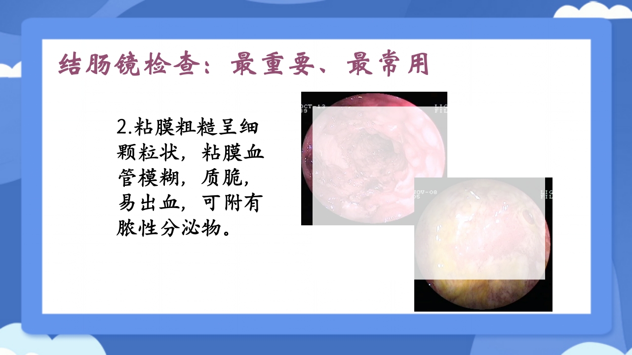 溃疡性结肠炎PPT课件22