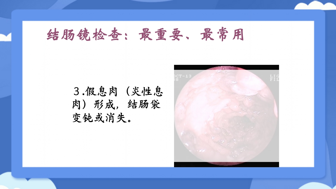 溃疡性结肠炎PPT课件23