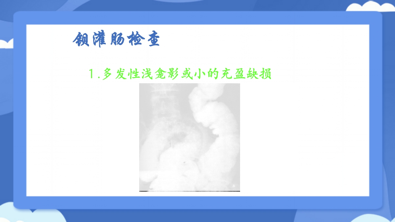 溃疡性结肠炎PPT课件25