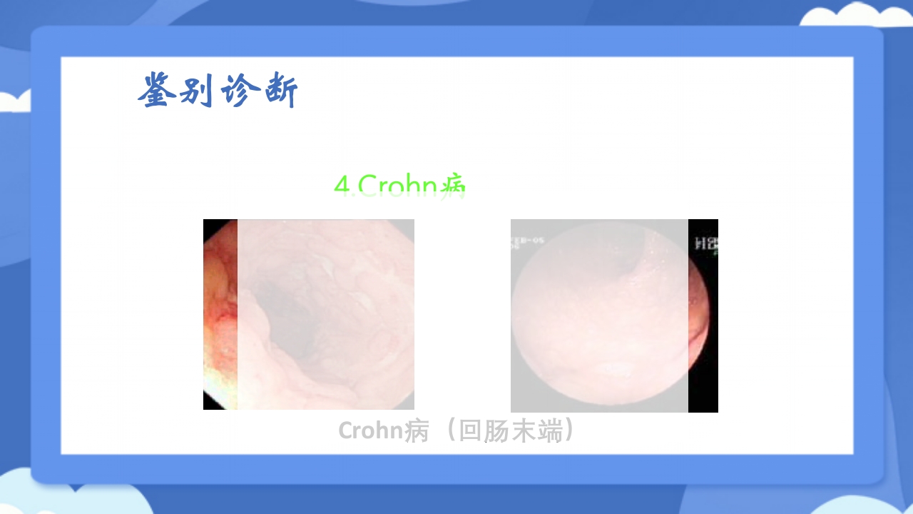 溃疡性结肠炎PPT课件41