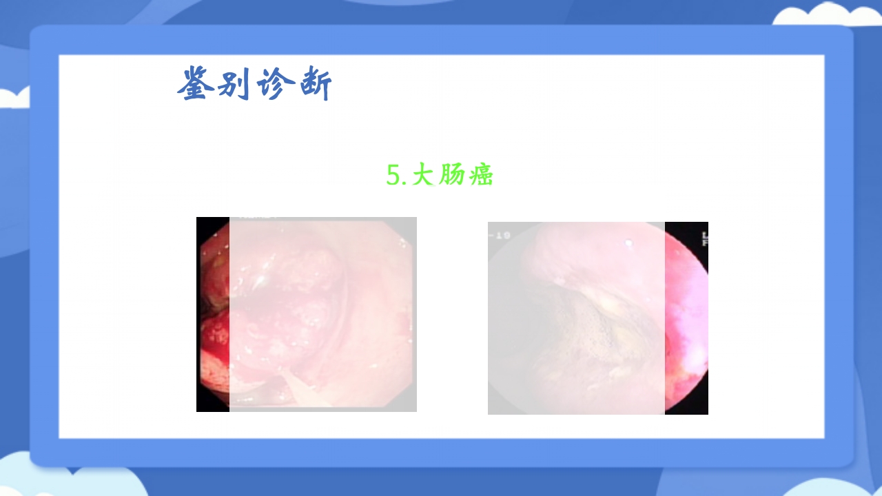 溃疡性结肠炎PPT课件42