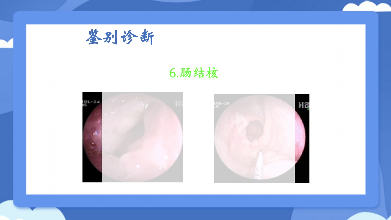 溃疡性结肠炎PPT课件43