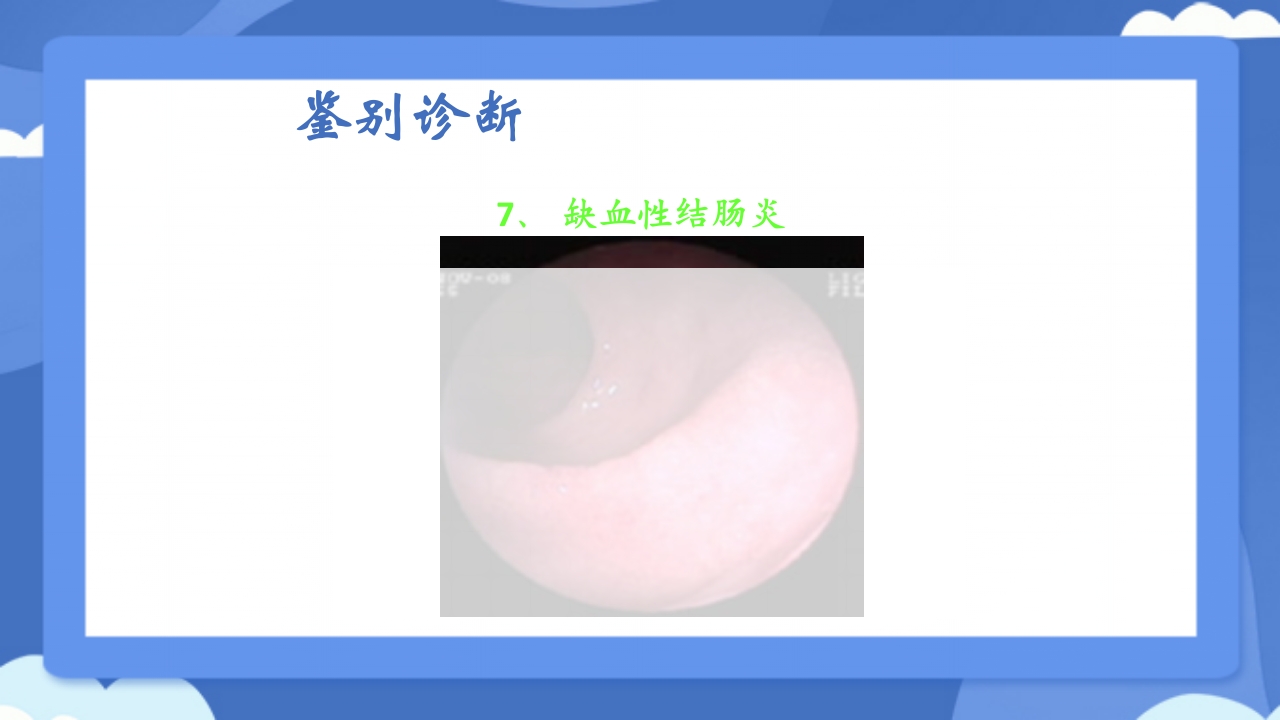 溃疡性结肠炎PPT课件44