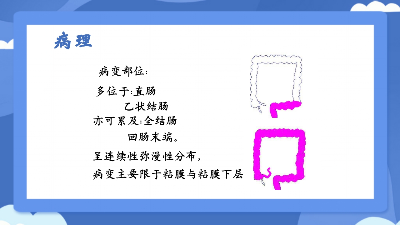 溃疡性结肠炎PPT课件6