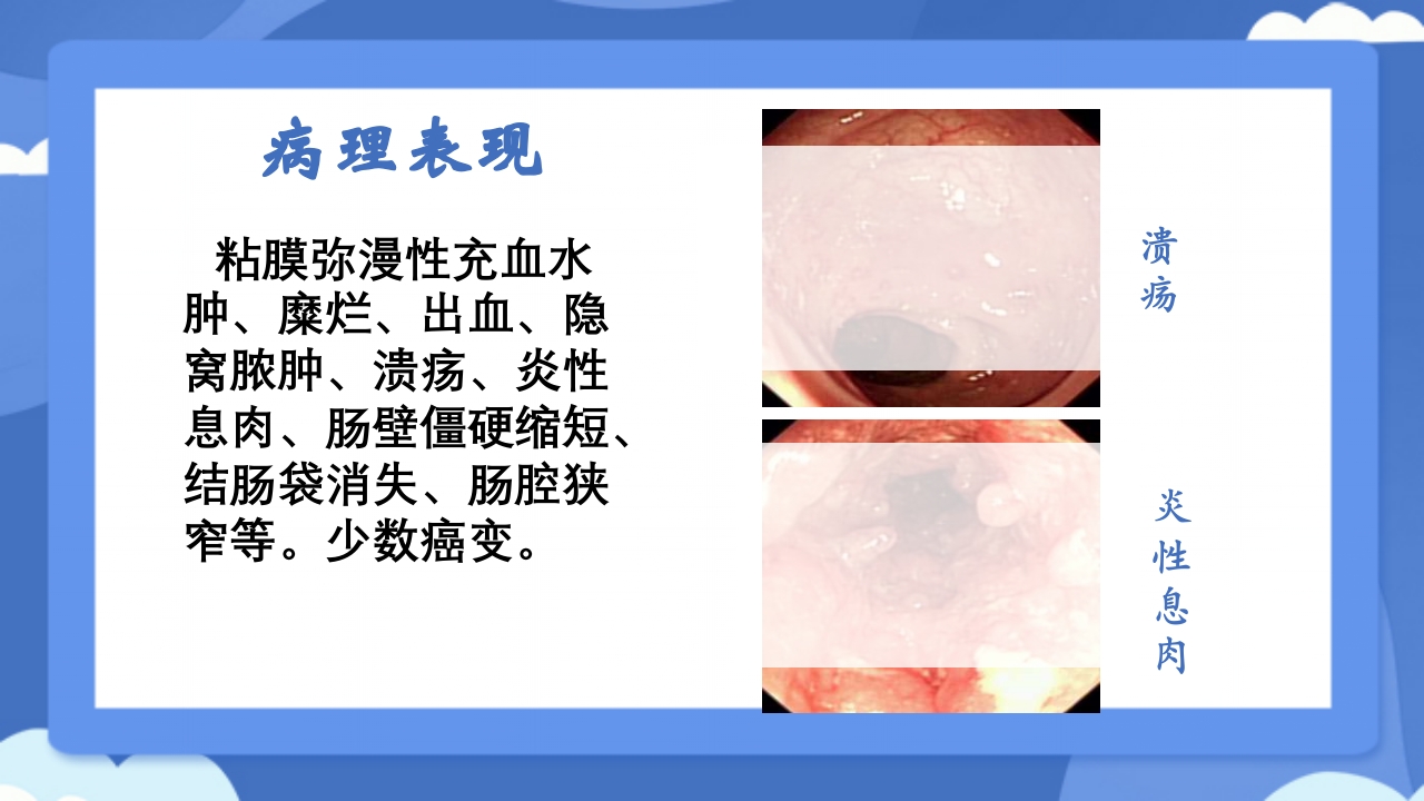 溃疡性结肠炎PPT课件7