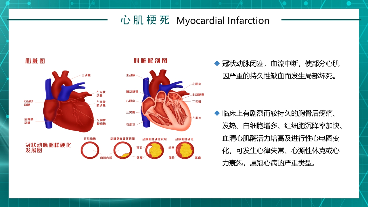 急性心梗护理查房规章知识讲座PPT课件14
