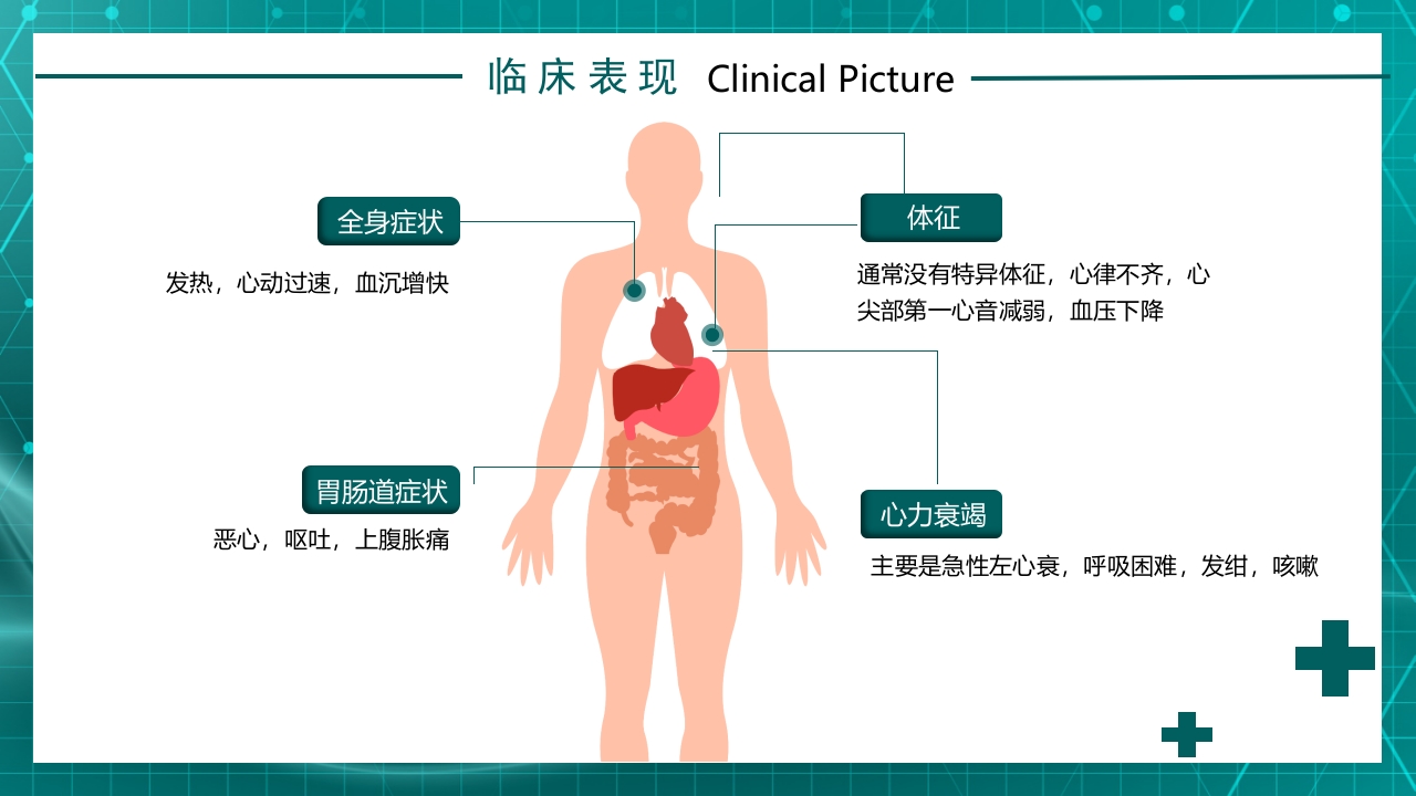急性心梗护理查房规章知识讲座PPT课件17