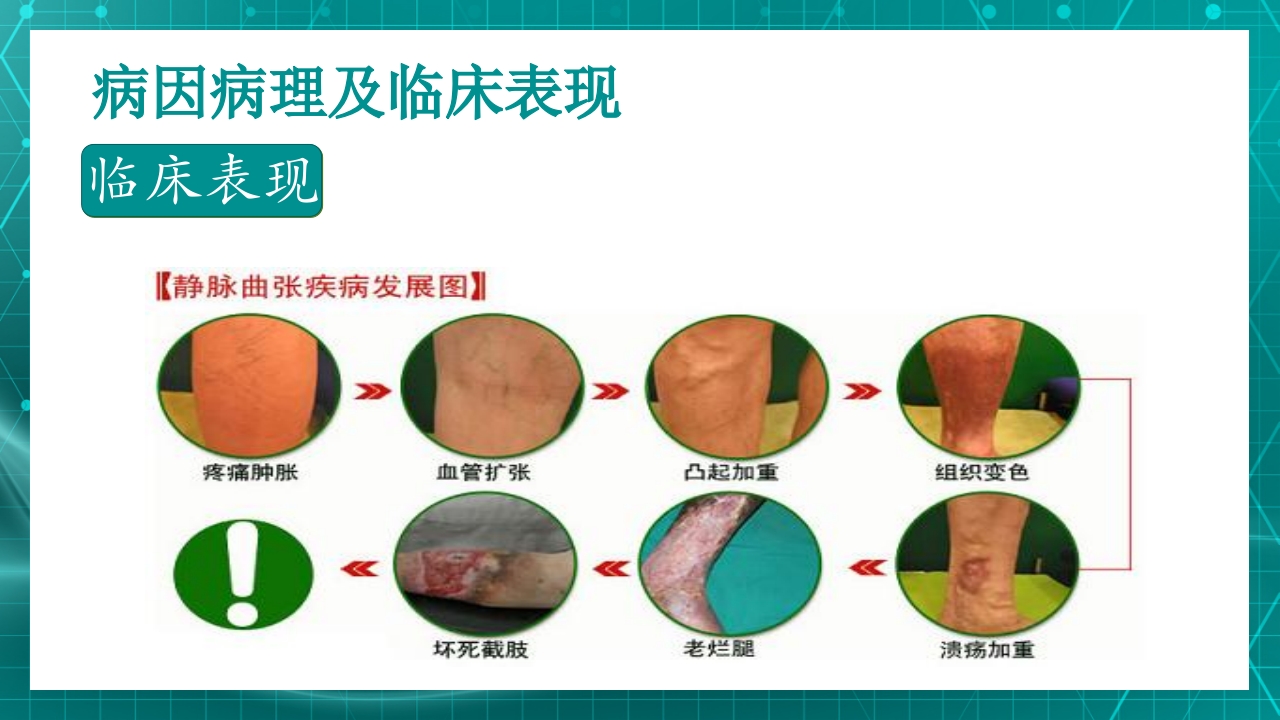 原发性下肢静脉曲张PPT课件15