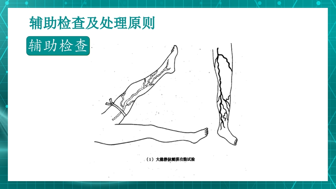 原发性下肢静脉曲张PPT课件17