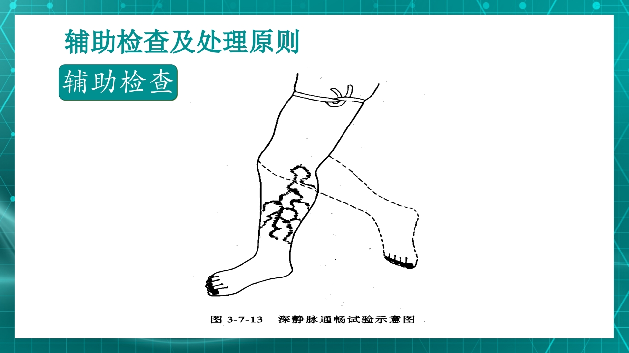 原发性下肢静脉曲张PPT课件18