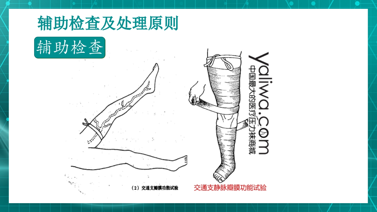 原发性下肢静脉曲张PPT课件19