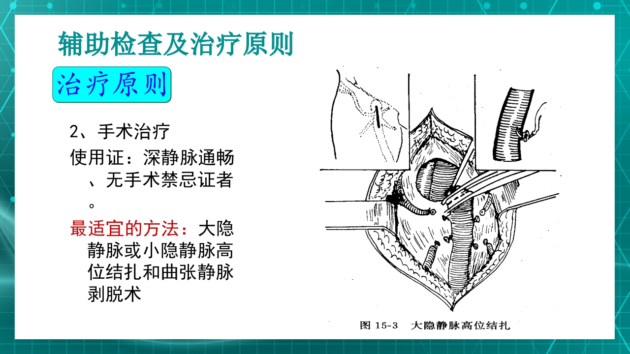 原发性下肢静脉曲张PPT课件21