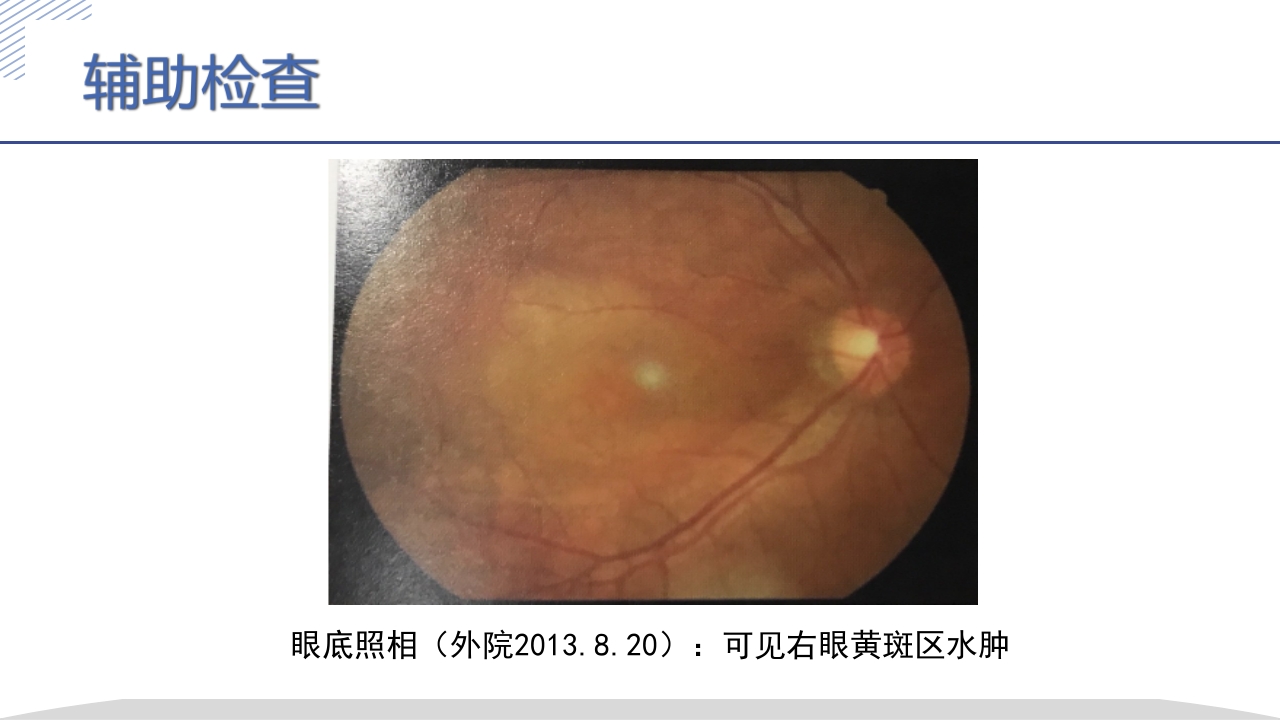 激素所致大泡视网膜脱离疑难病例讨论PPT课件6