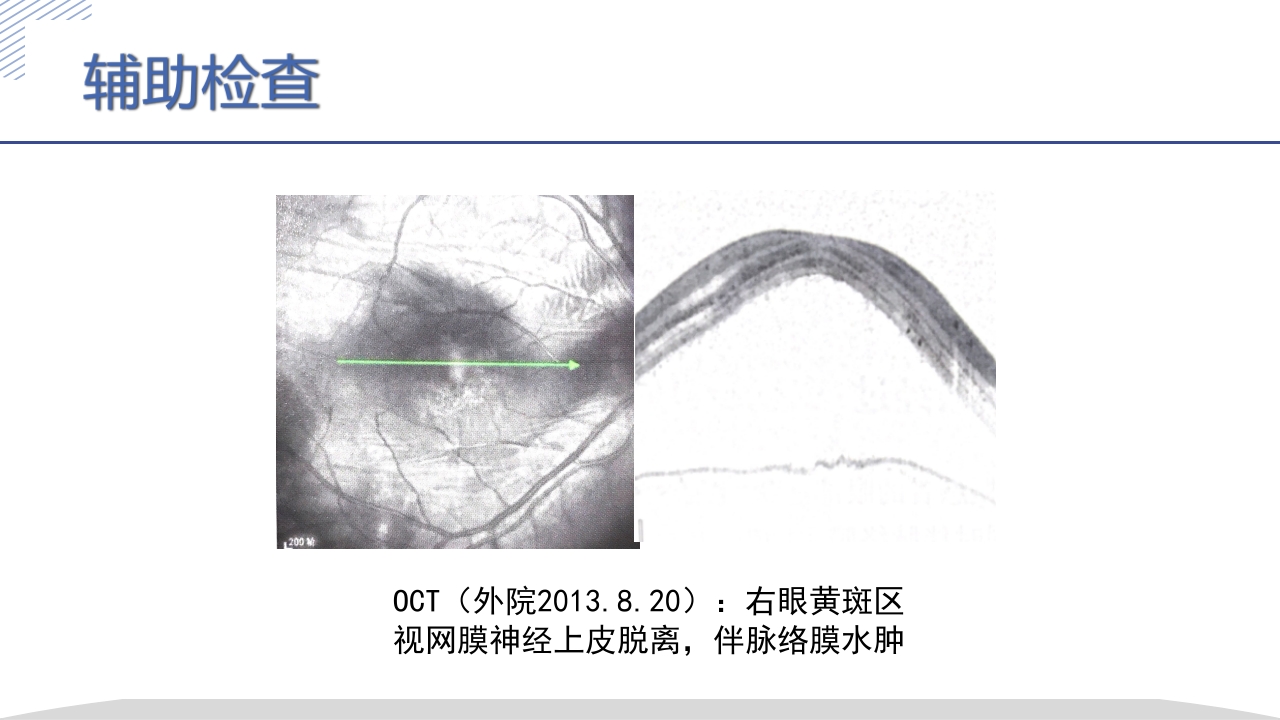 激素所致大泡视网膜脱离疑难病例讨论PPT课件7