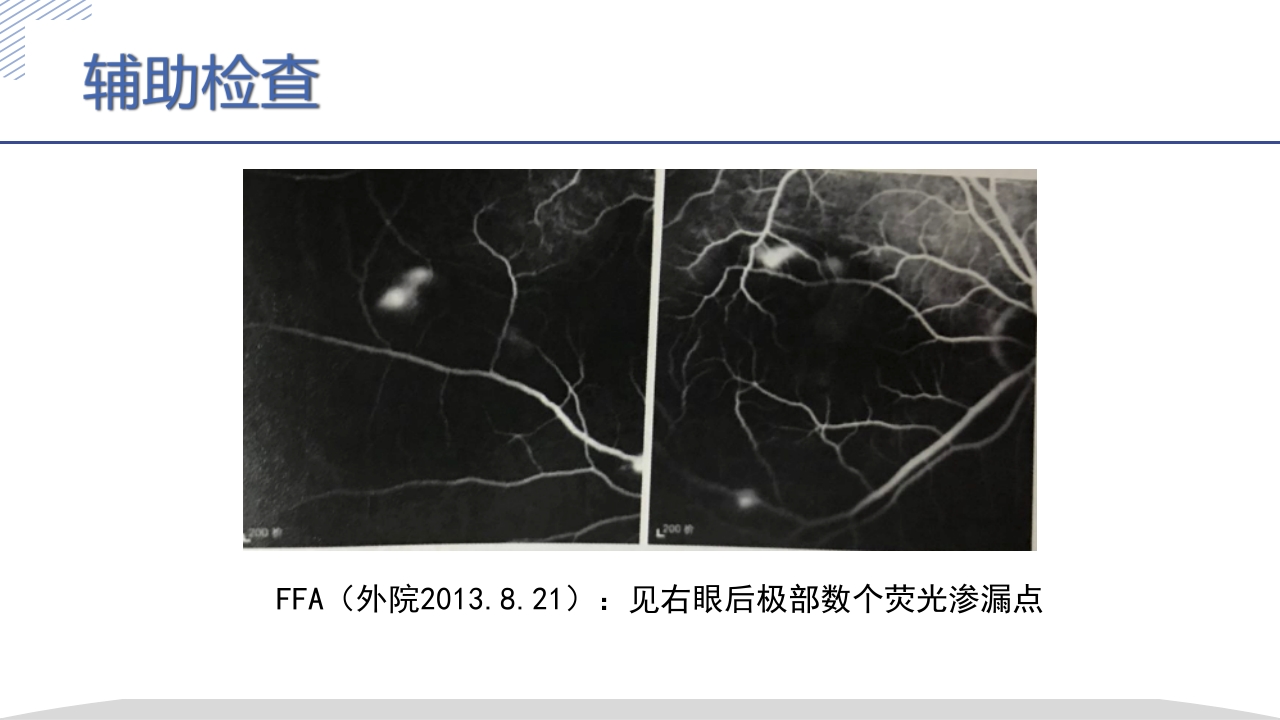 激素所致大泡视网膜脱离疑难病例讨论PPT课件8