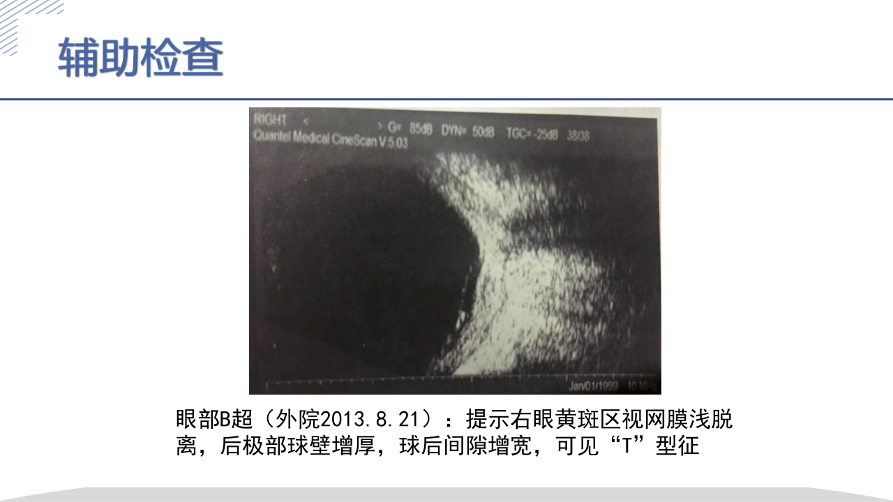激素所致大泡视网膜脱离疑难病例讨论PPT课件9