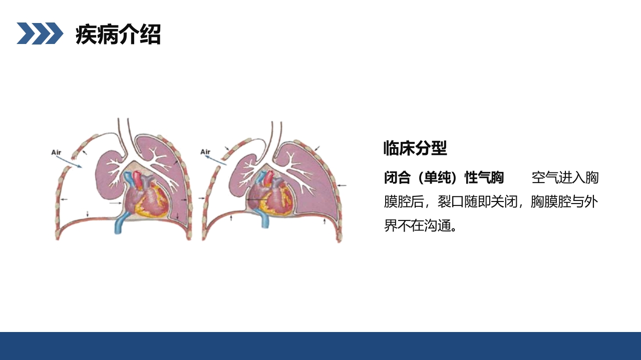 结核性胸膜炎患者护理查房PPT课件7