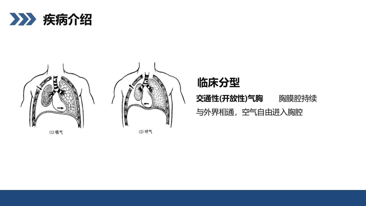 结核性胸膜炎患者护理查房PPT课件8