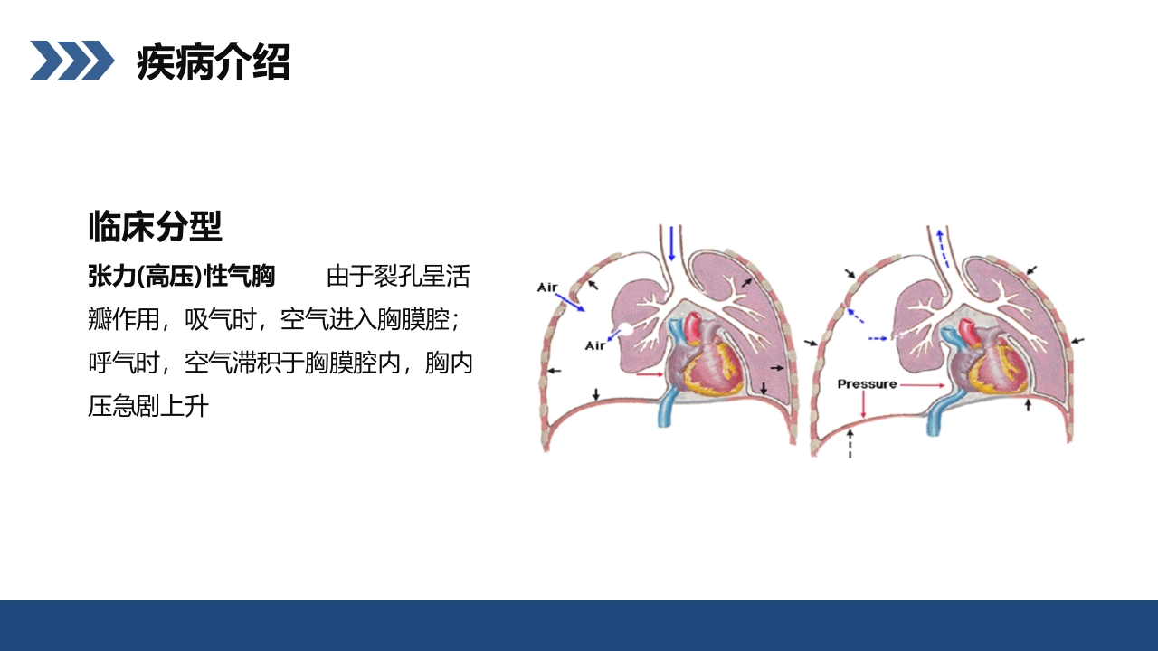 结核性胸膜炎患者护理查房PPT课件9