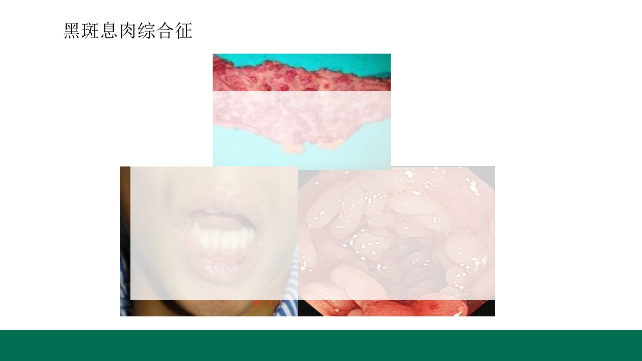 胃息肉的内镜治疗PPT课件12