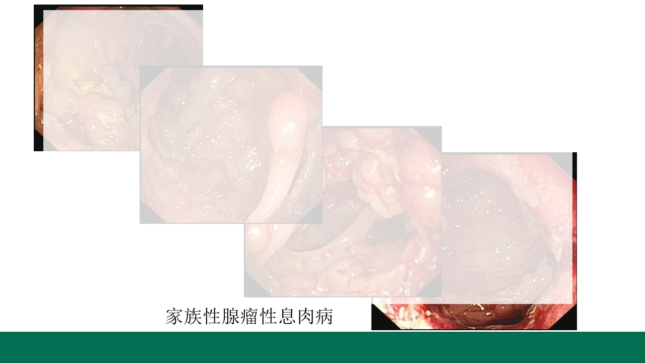 胃息肉的内镜治疗PPT课件14