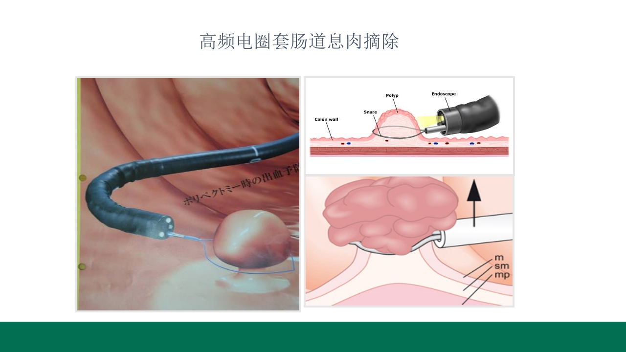 胃息肉的内镜治疗PPT课件24