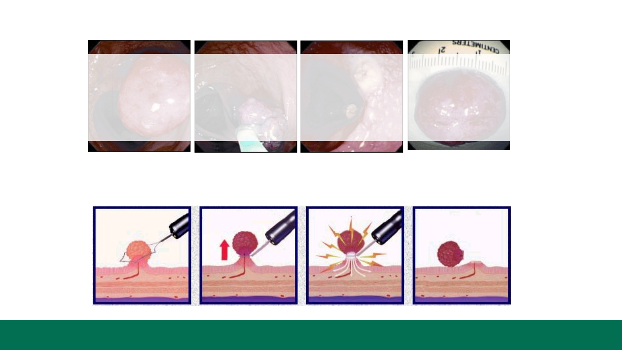 胃息肉的内镜治疗PPT课件25