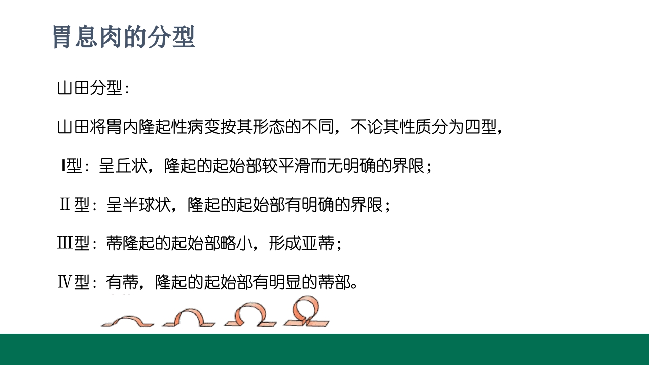 胃息肉的内镜治疗PPT课件5