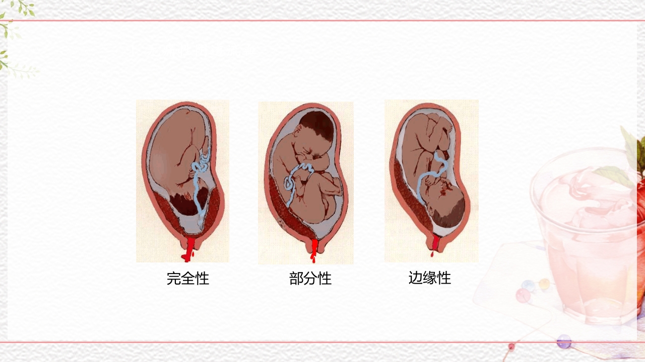 一例介入联合子宫全切救治的并立讨论PPT课件13