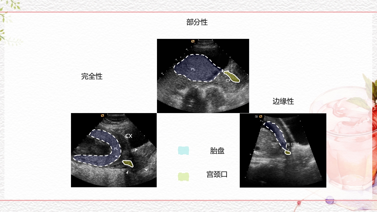 一例介入联合子宫全切救治的并立讨论PPT课件20