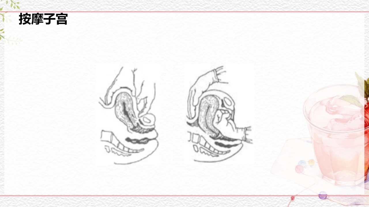 一例介入联合子宫全切救治的并立讨论PPT课件33