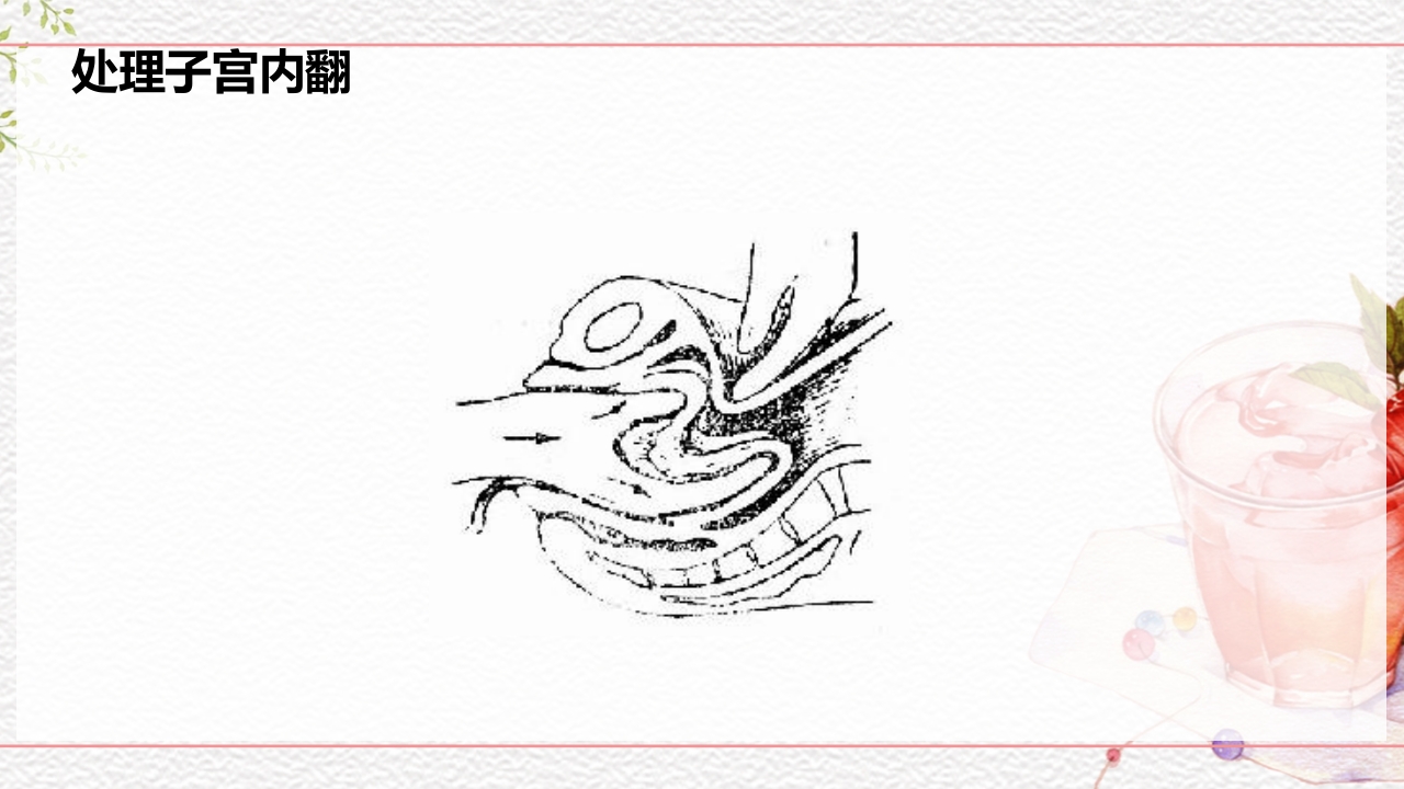 一例介入联合子宫全切救治的并立讨论PPT课件35