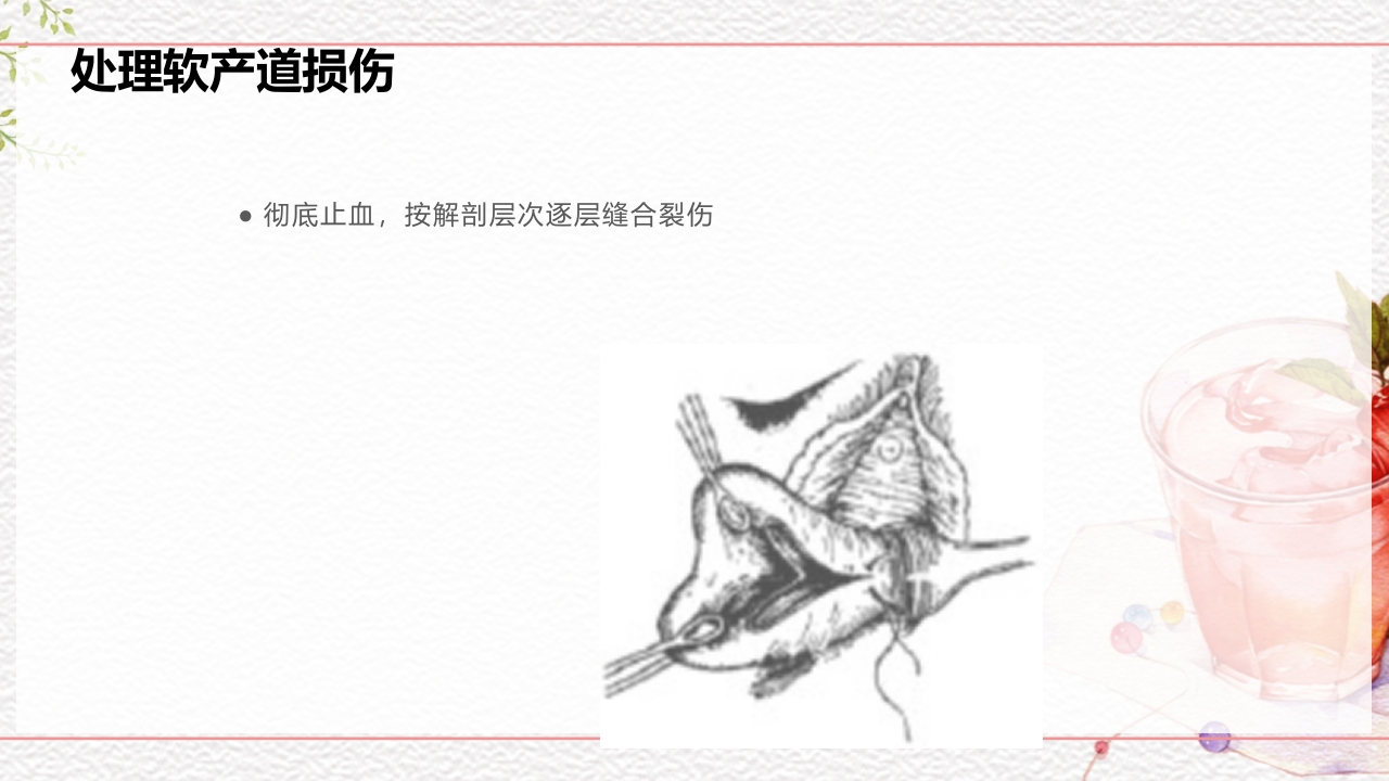 一例介入联合子宫全切救治的并立讨论PPT课件36