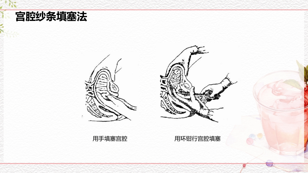一例介入联合子宫全切救治的并立讨论PPT课件39
