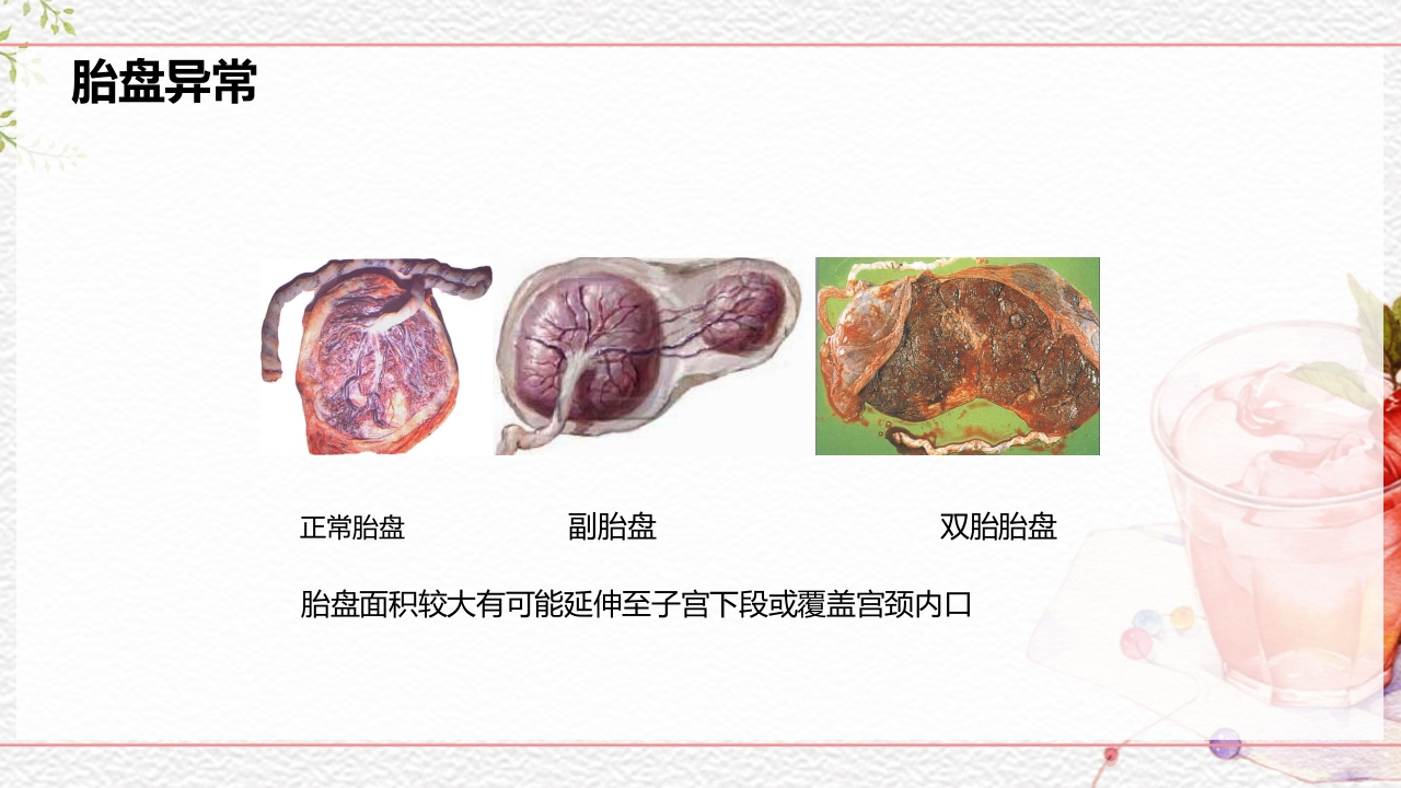 一例介入联合子宫全切救治的并立讨论PPT课件43