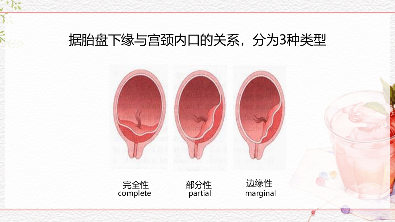 一例介入联合子宫全切救治的并立讨论PPT课件9