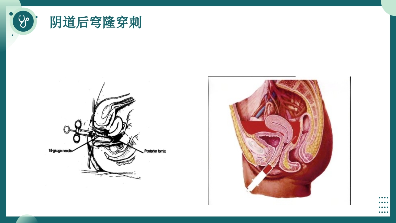 妇科护理查房PPT课件8