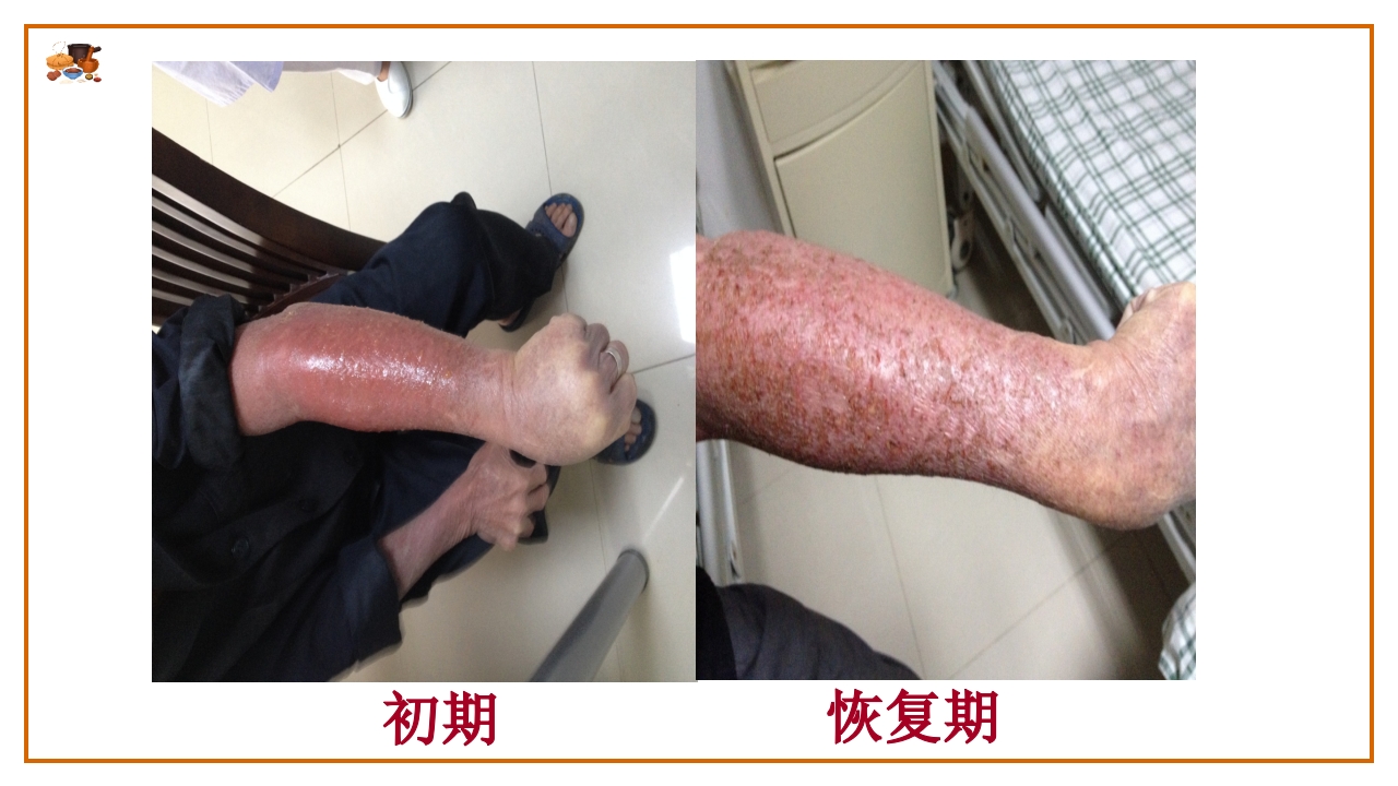 湿疮中医护理查房(严重湿疹)ppt课件12