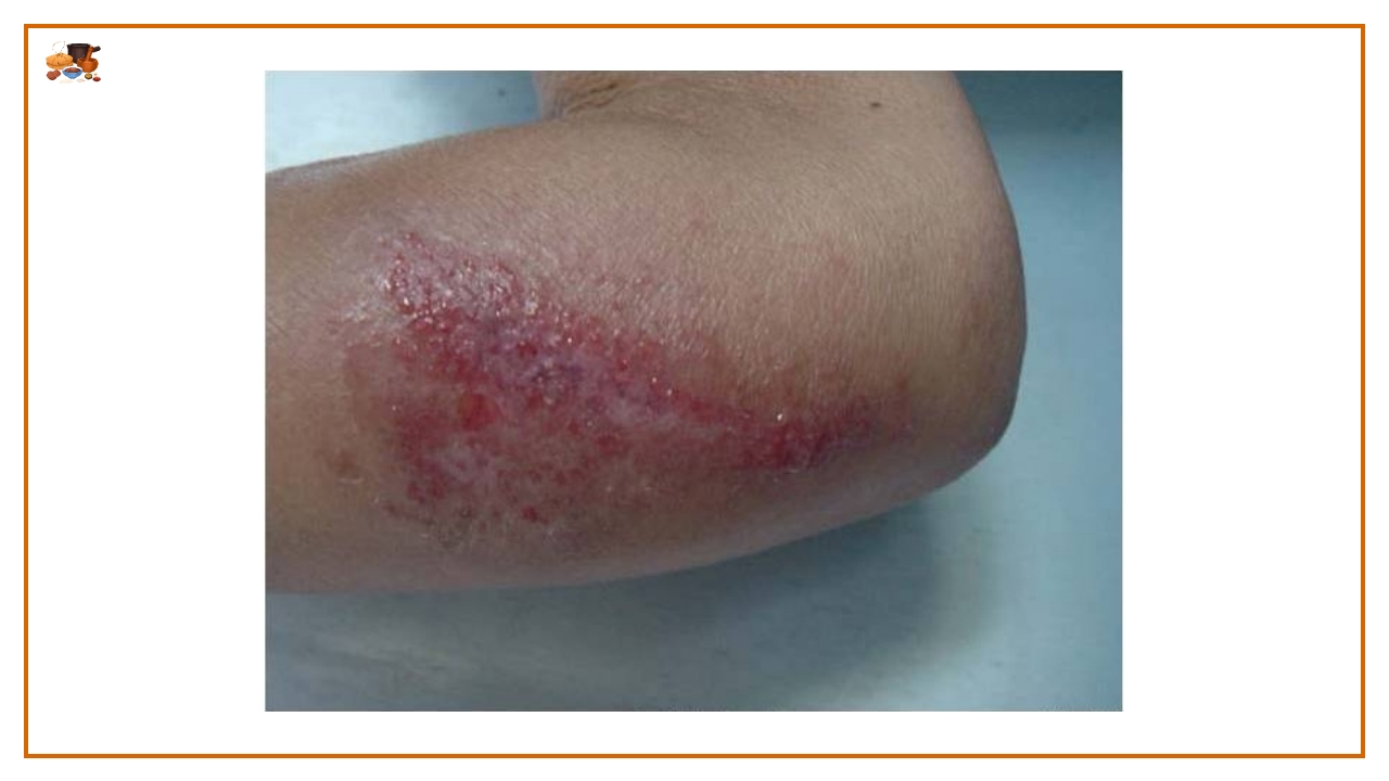 湿疮中医护理查房(严重湿疹)ppt课件22