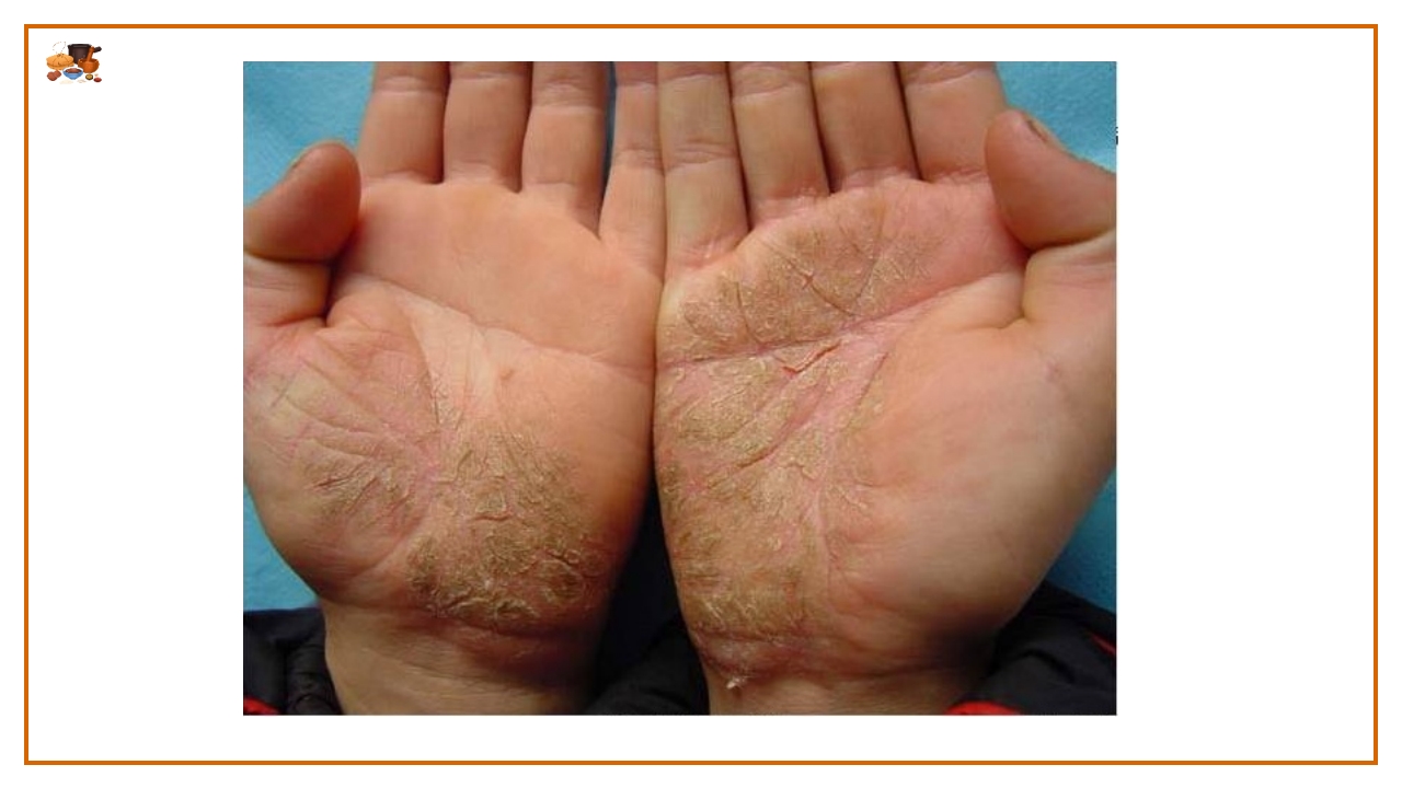 湿疮中医护理查房(严重湿疹)ppt课件26