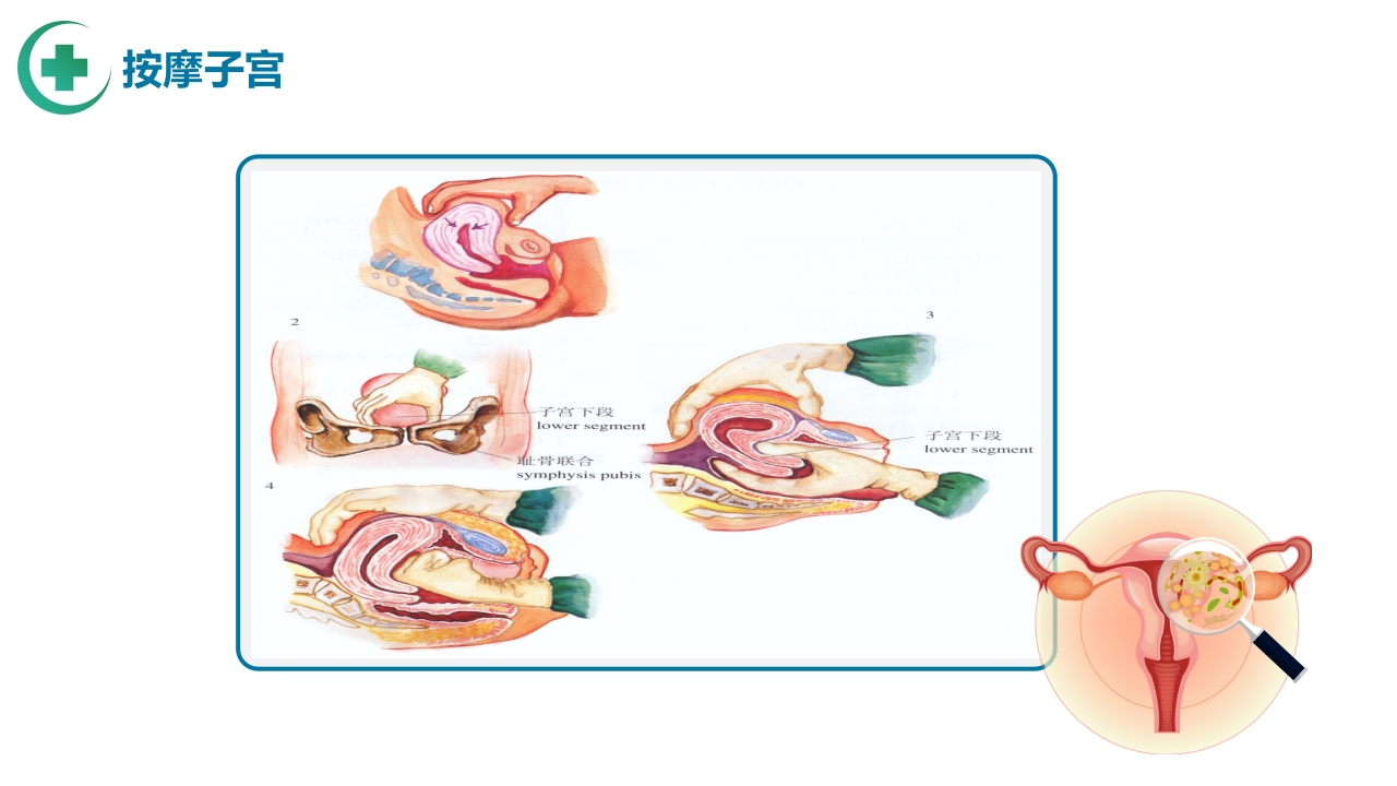 医疗产后出血护理PPT课件19