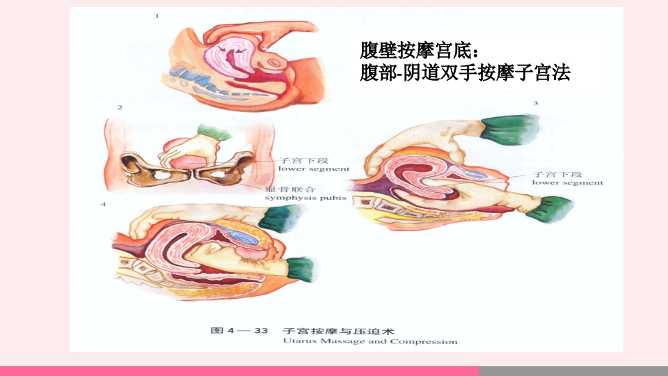 产后出血的观察与护理PPT课件23
