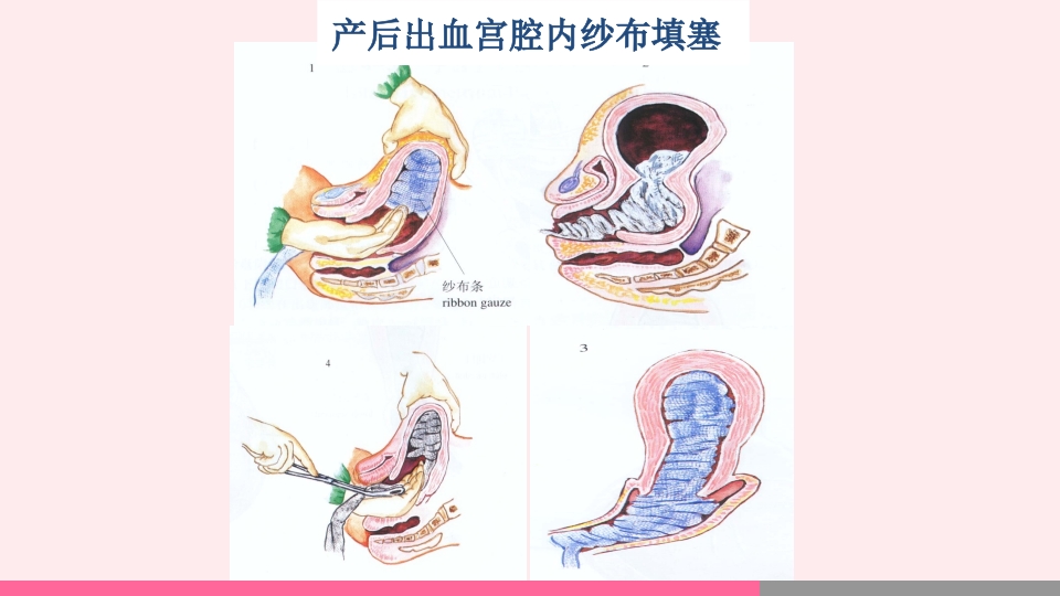 产后出血的观察与护理PPT课件24